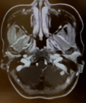 四川女子大脑吃出虫子,四川最易感染的寄生虫