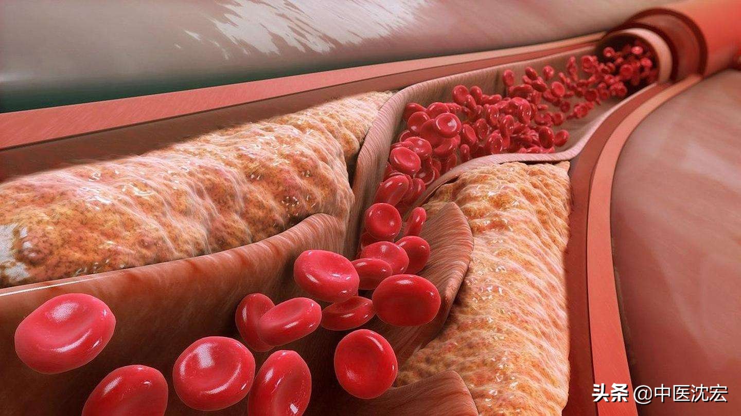 血瘀体质易得心梗吗,血瘀体质容易心梗