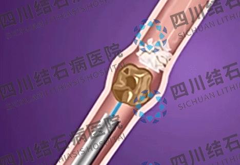 结石尿出来就好了吗,输尿管结石95mm结石能排出吗