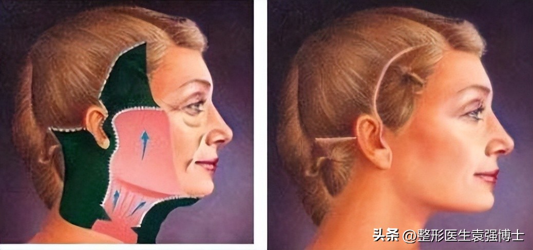 拉皮手术会加速衰老吗亲身经历,脸部松垮下垂拉皮还是填充