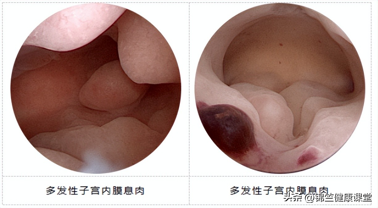 滴滴答答不干净，可能是这个地方长息肉了
