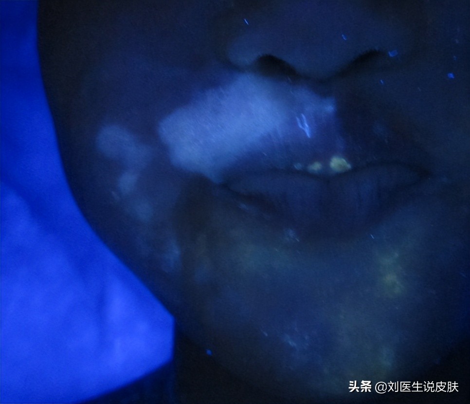 白癜风怎么彻底治愈,白癜风怎么快速治