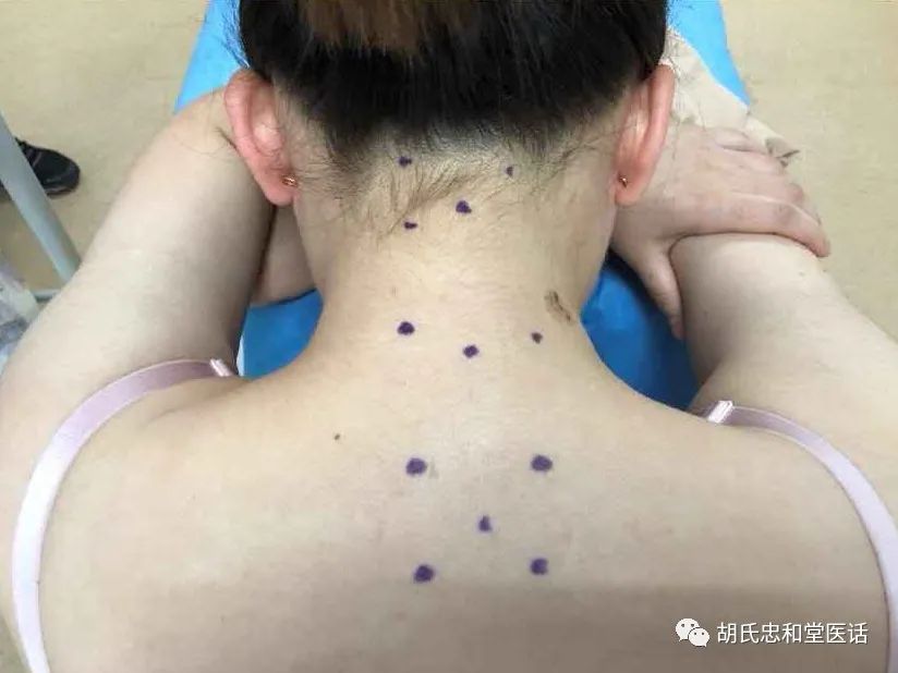 针灸中的针与灸的区别,针灸穴位与按穴位有什么区别