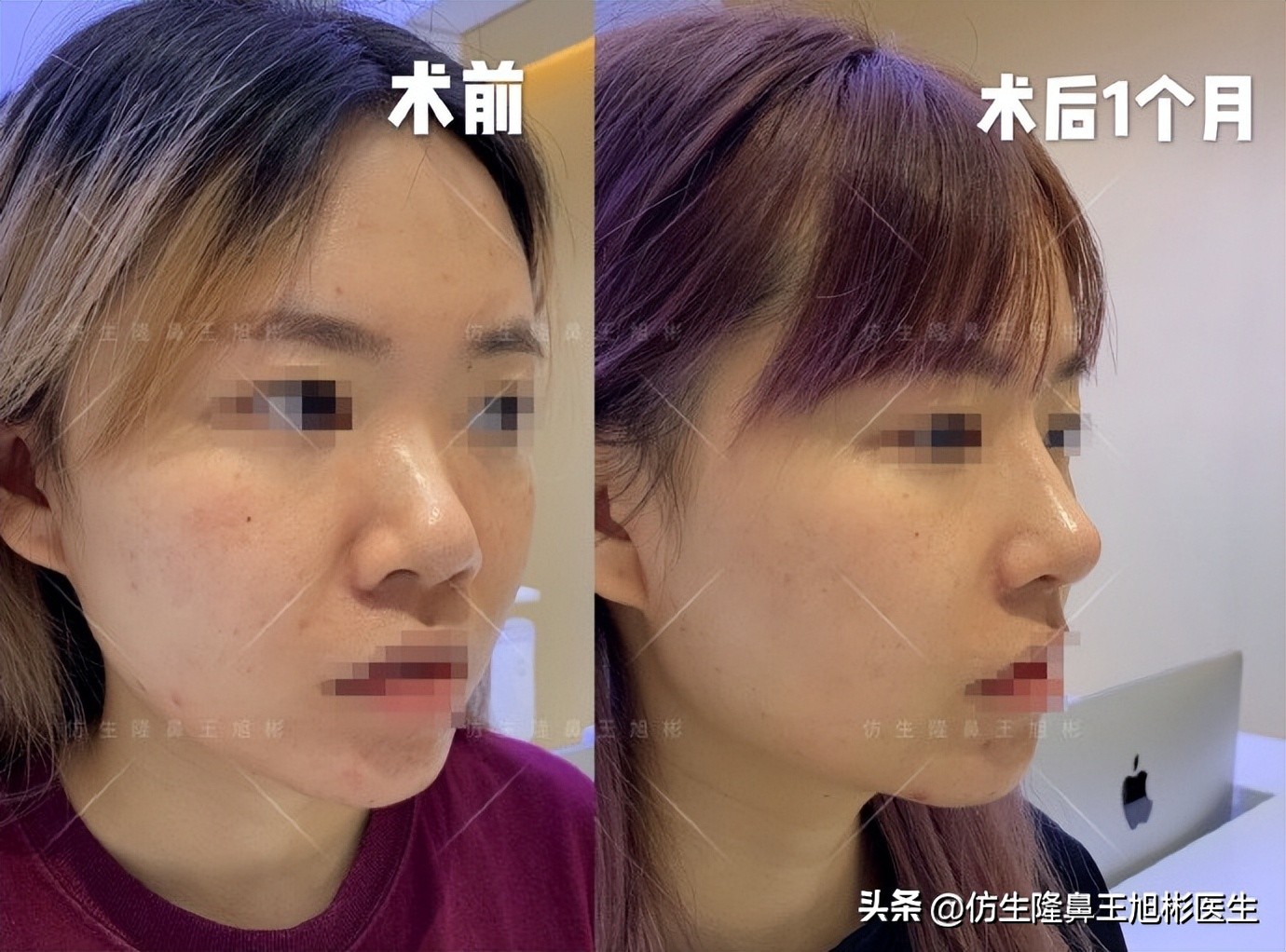 短鼻延长,短鼻塌鼻可以逆袭变长吗