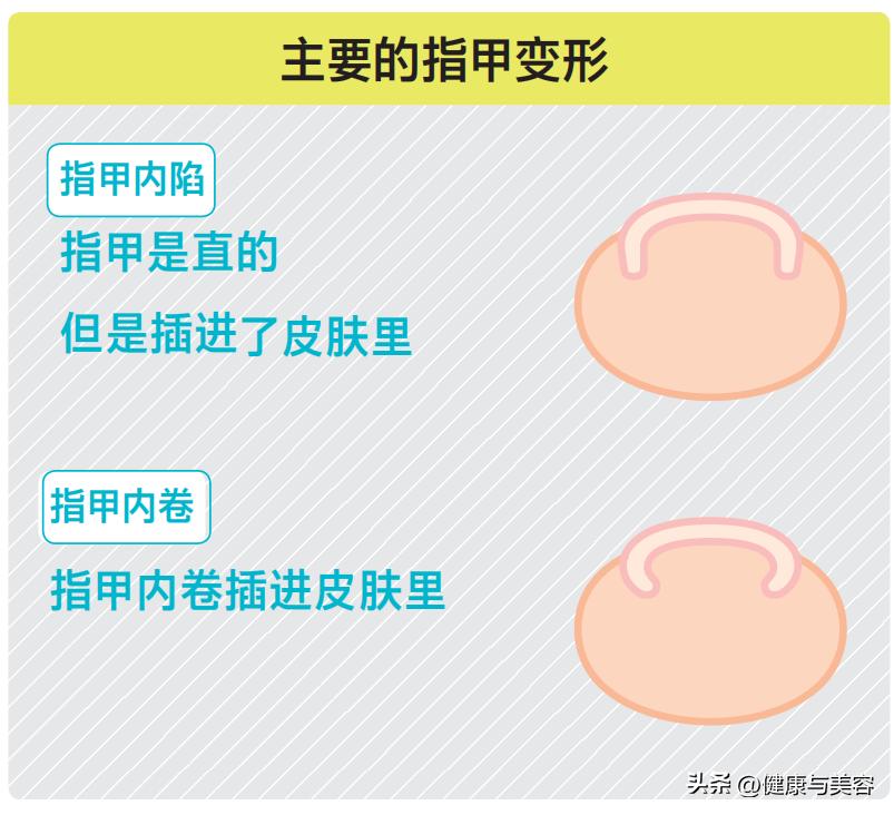 指甲卷曲内卷,指甲卷曲用什么药