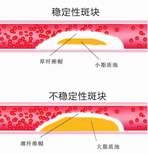 如何检查心梗和脑梗有问题,心梗脑梗可以查出来吗