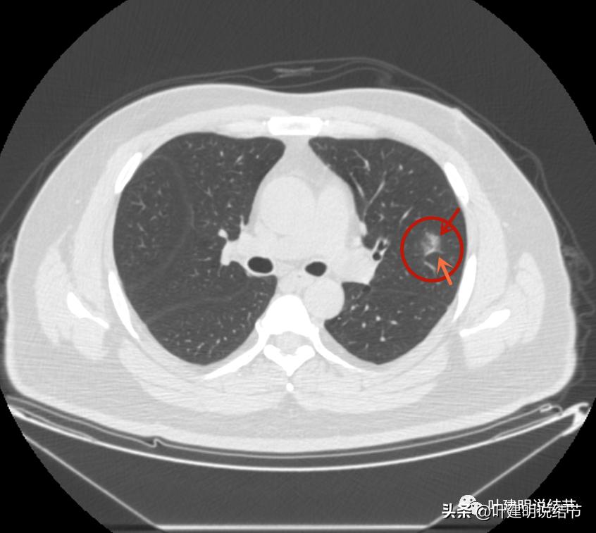 如何判断肺磨玻璃结节是高危结节,肺上有混合磨玻璃结节要注意什么