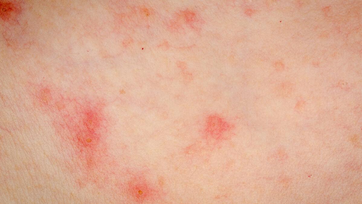 湿疹痱子如何辨别,湿疹和痱子怎么能分清楚