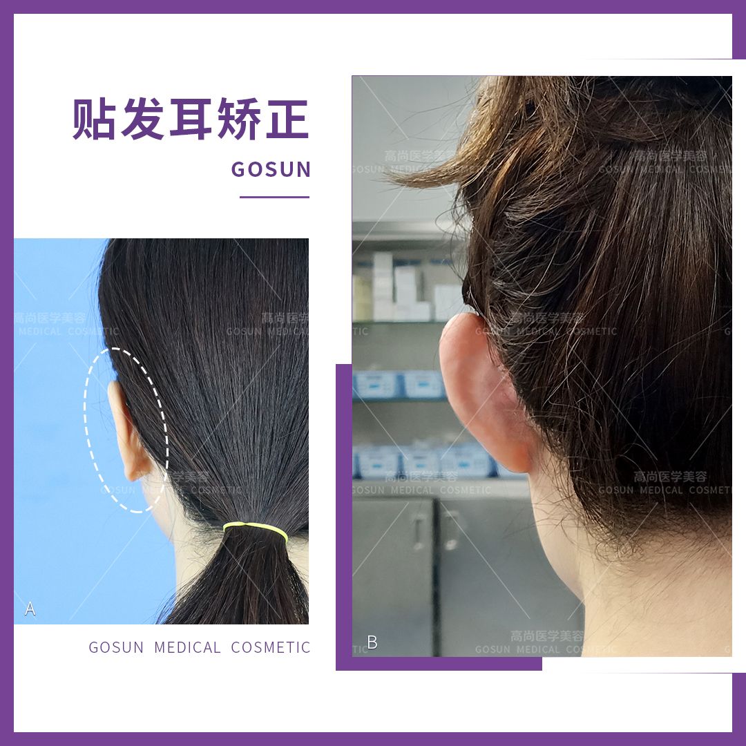 贴耳朵显脸大,贴发耳会改变脸型么