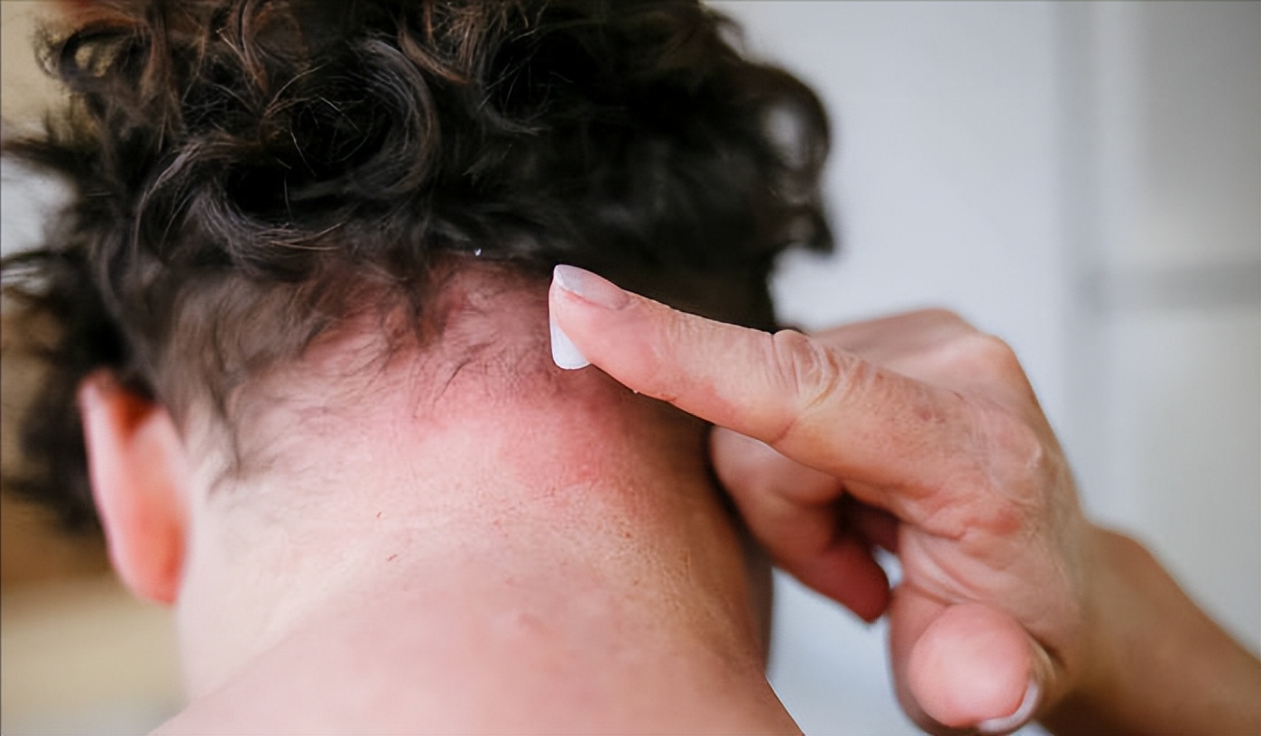 银屑病中医辨证论治根源,中药外用治银屑病研究进展