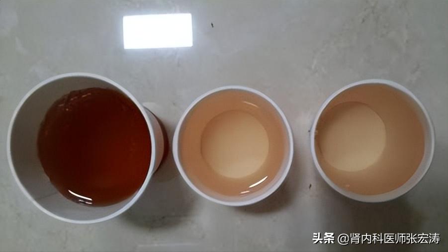 如何解读医学检验单之尿常规,尿常规检验报告单解读