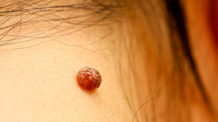 男人脖子上长了瘊子是hpv引起的吗,男人脖子上有丝状疣就有hpv病毒吗