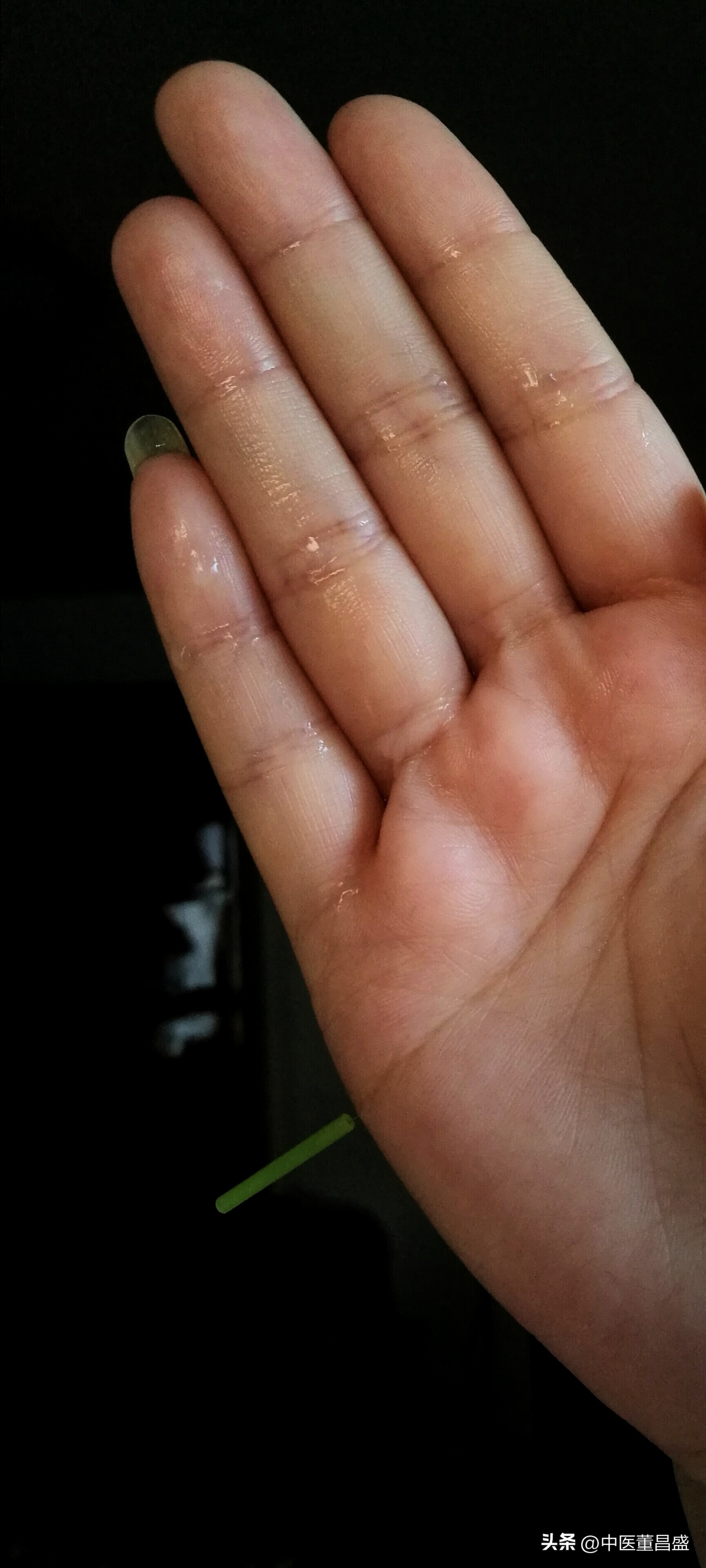 腰痛针炙特效穴立竿见影,老中医火针治疗腰痛