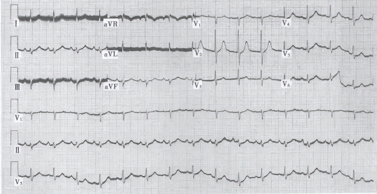 心电图机干扰信号过大的原因,心电伪差一般是指哪些干扰