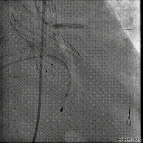 病例回顾与分享,腹膜后血肿介入治疗