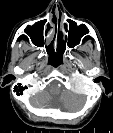 影像诊断笔记-颈静脉球瘤