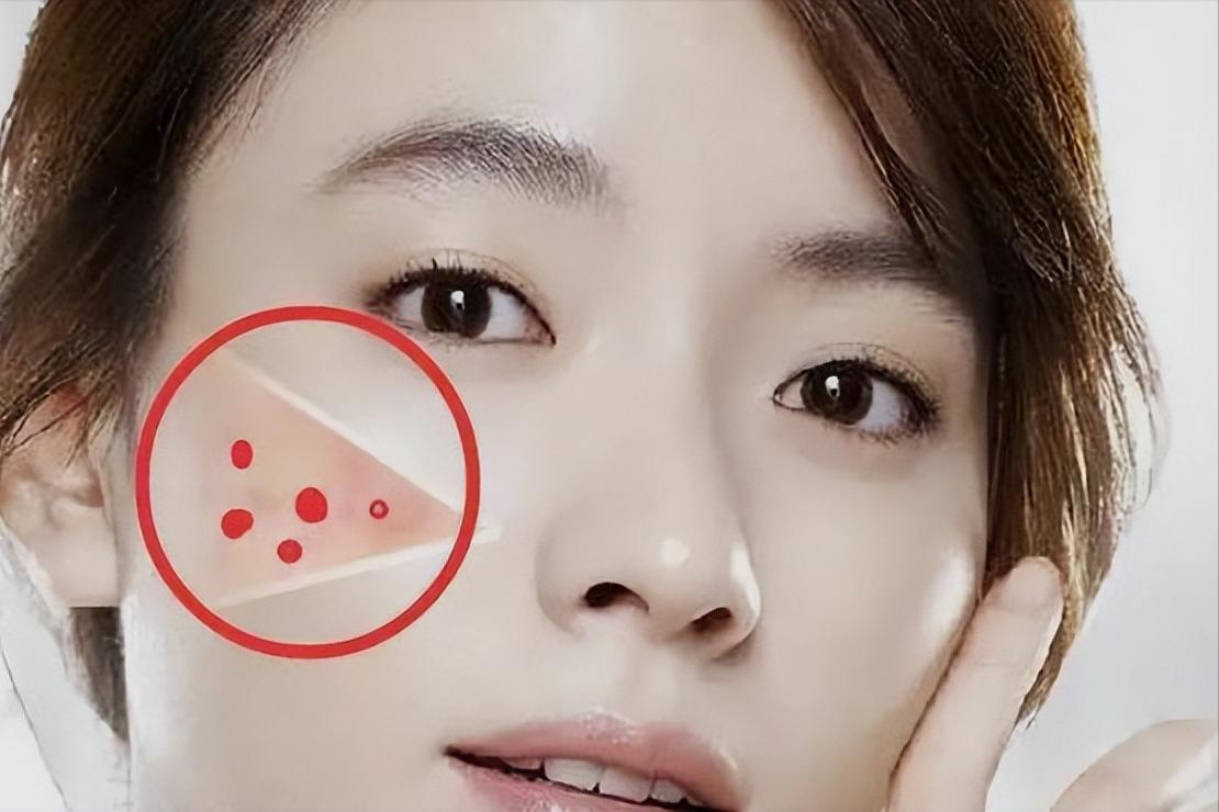 女生一来例假就长痘是什么原因,女生姨妈来了爆痘怎么办