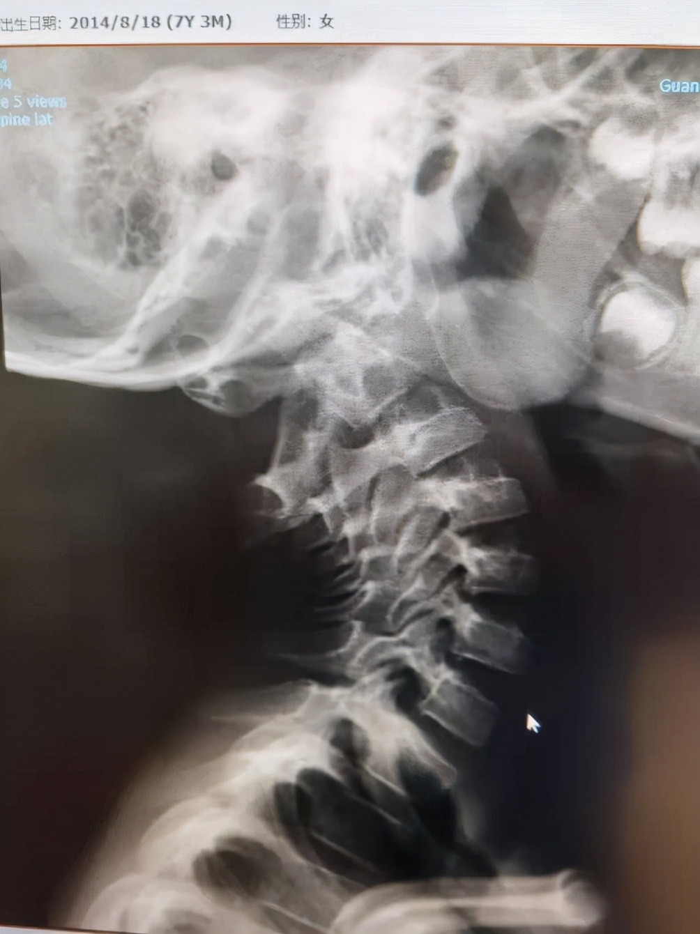 儿童落枕最快恢复办法,落枕了30秒自愈方法儿童