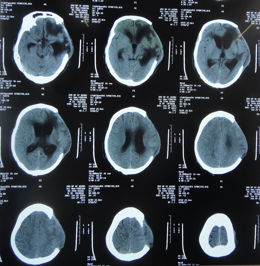 脑外伤开颅手术后继发癫痫,开颅术后颅内感染