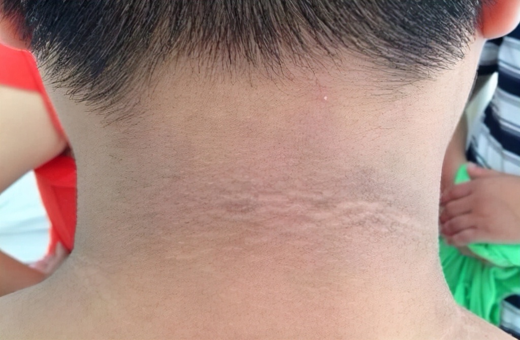 脖子黑一圈洗也洗不掉是怎么了,脖子上洗不干净黑黑的怎么办