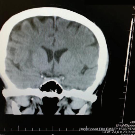 腰硬联合麻醉行剖宫产术后发现急性丘脑出血,一个罕见病例!