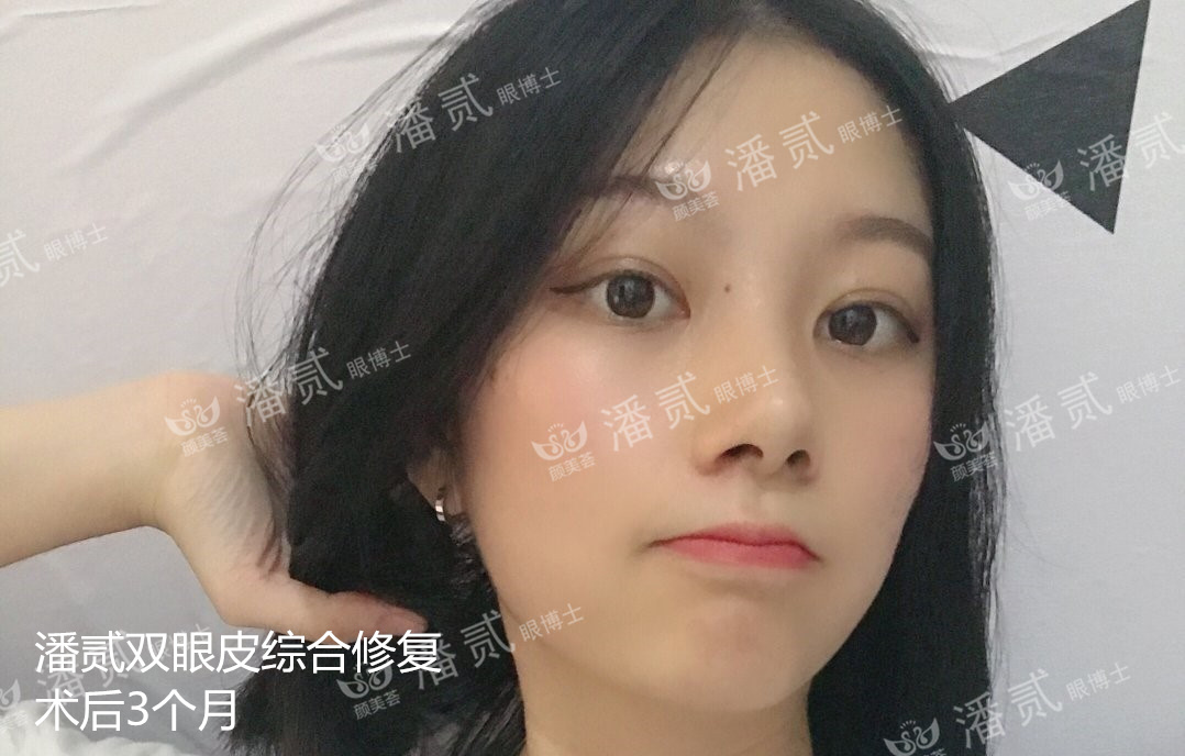 双眼皮贴导致眼皮破了,双眼皮贴导致眼皮严重下垂恢复