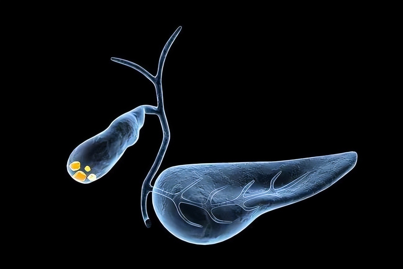 胆囊附壁胆固醇结晶是怎么回事,招飞体检会查幽门螺杆菌吗