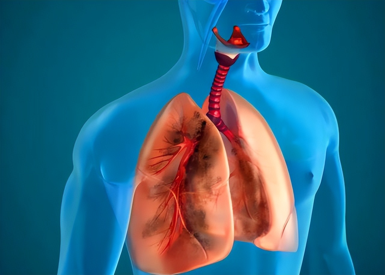 肺部黄痰与白痰区别,痰在肺部怎么形成的
