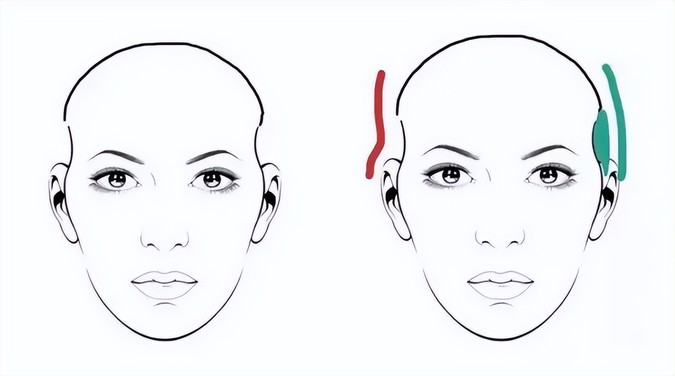 九院韦敏改脸型,九院填充太阳穴失败案例