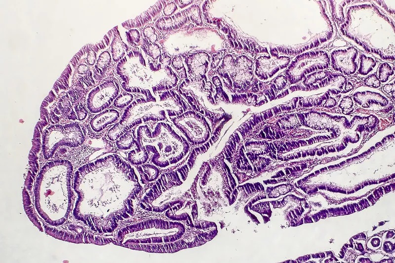 肠息肉会遗传，可致癌！家人患肠息肉，直系亲属肠癌风险增加43%