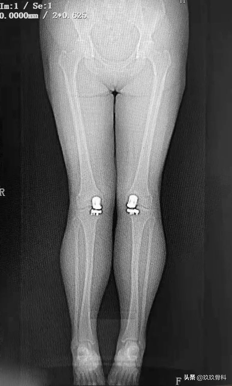 贵阳东方骨科医院膝关节置换,骨科单髁置换手术