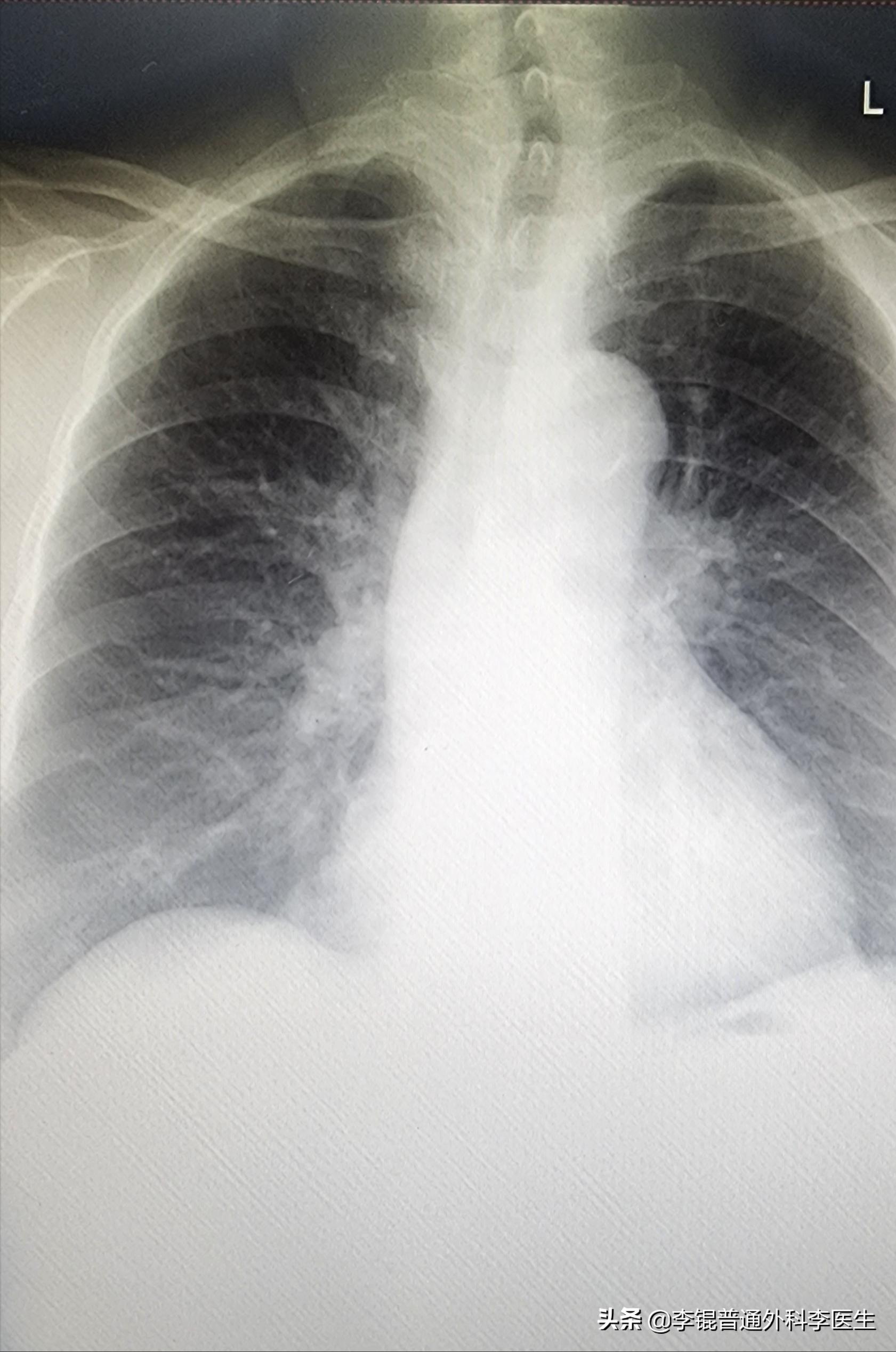 老人肺炎一整个肺都不好使怎么办,老人肺炎反反复复能治好吗