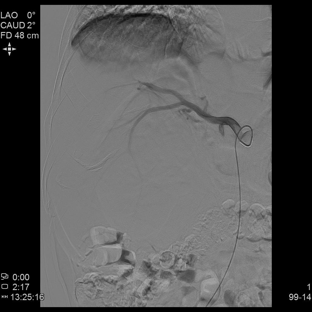 介入栓塞联合靶向,介入联合靶向能消除癌栓吗