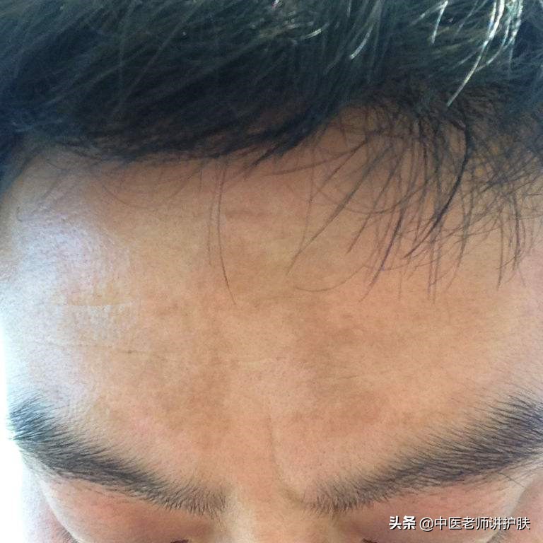 色斑也得分类别,从中医角度浅谈色斑成因,这样治疗更有效