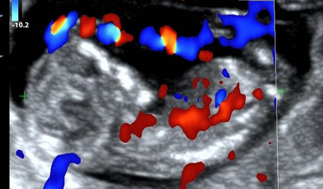 怀孕三个月胎儿是什么样的,怀孕三个月平躺可以摸到胎儿吗