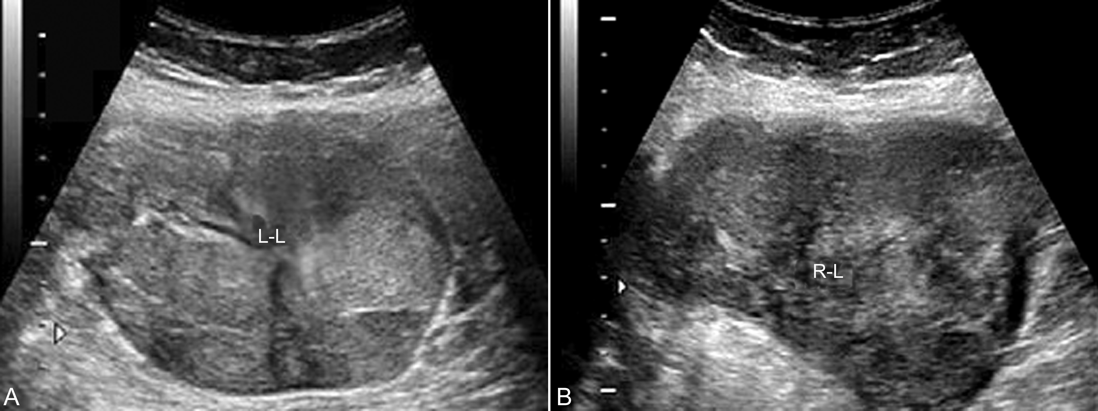 妊娠合并卵巢良性肿瘤,妊娠合并卵巢肿瘤是恶性吗