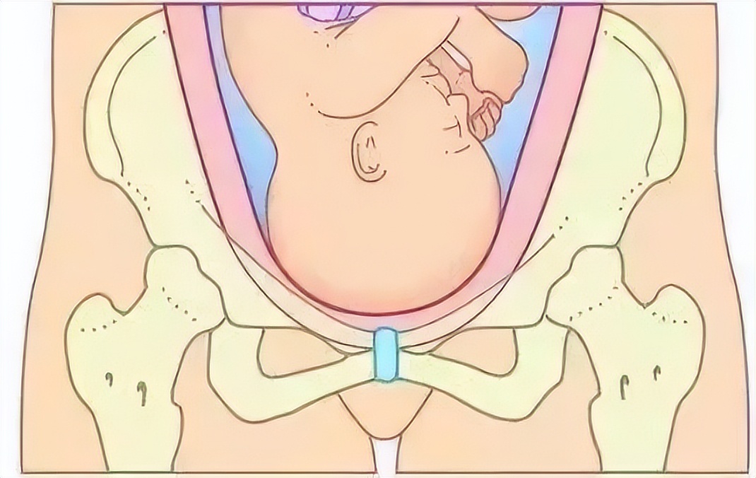 产后盆底肌肉受损怎么治疗,产后漏尿严重盆底肌可以恢复吗