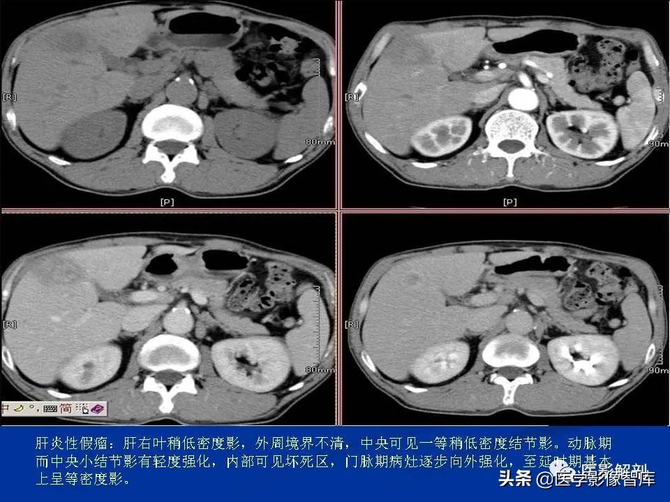 肝炎性假瘤鉴别诊断,肝炎性假瘤影像学表现