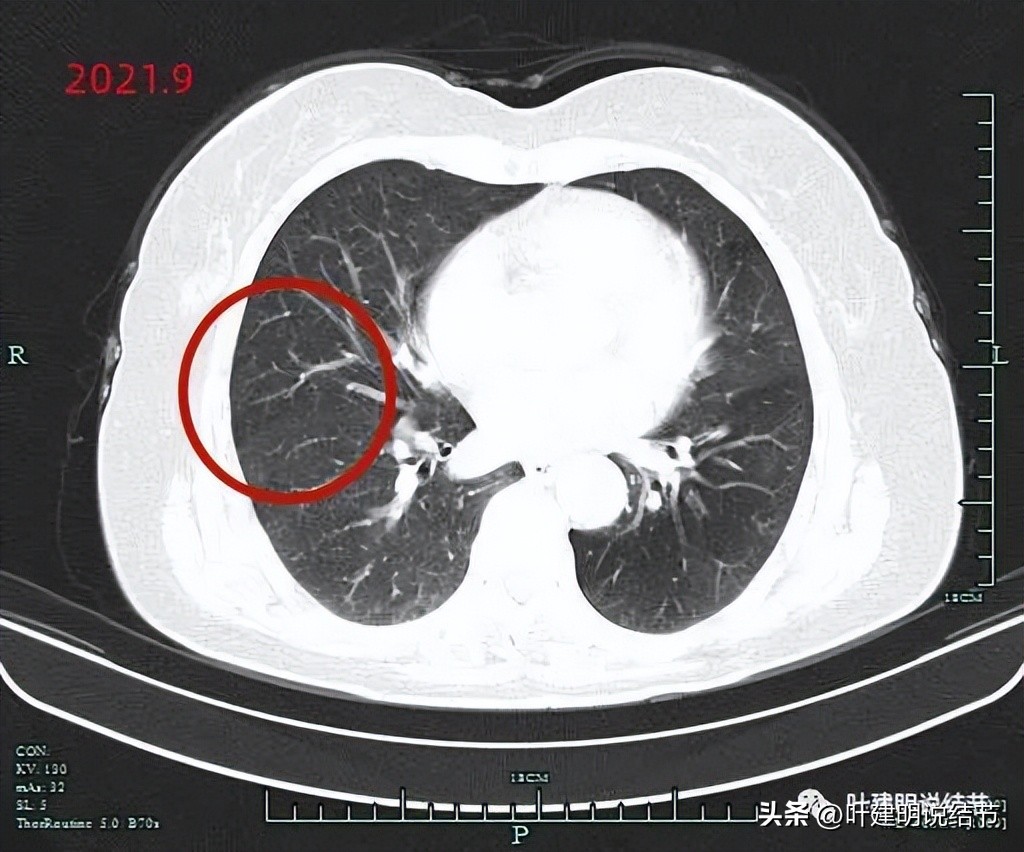 子宫内膜癌术后病灶大于二厘米,子宫内膜癌手术后一年又发现肺癌