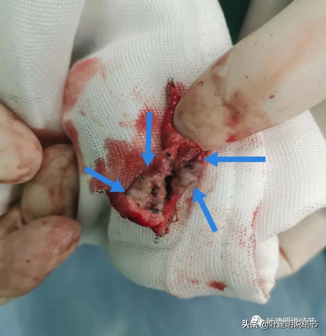 2cm的肺磨玻璃结节如何处理最合适,年轻女人磨玻璃结节