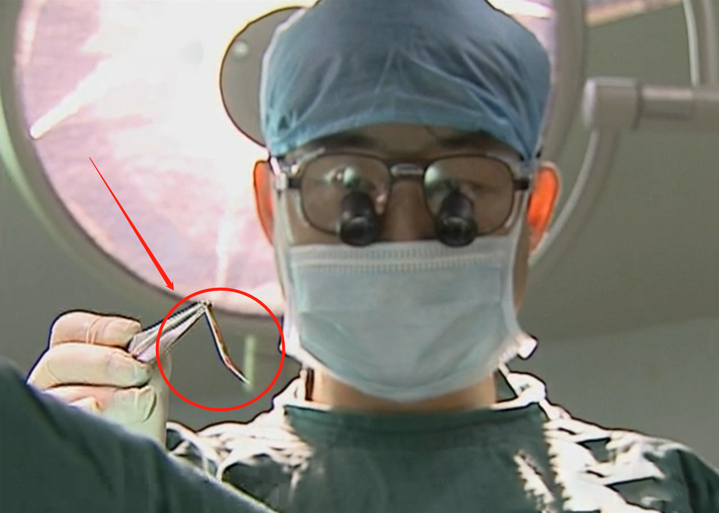 2010年,厦门小伙连续3月反复高烧,医生打开心脏夹出3厘米的鱼刺