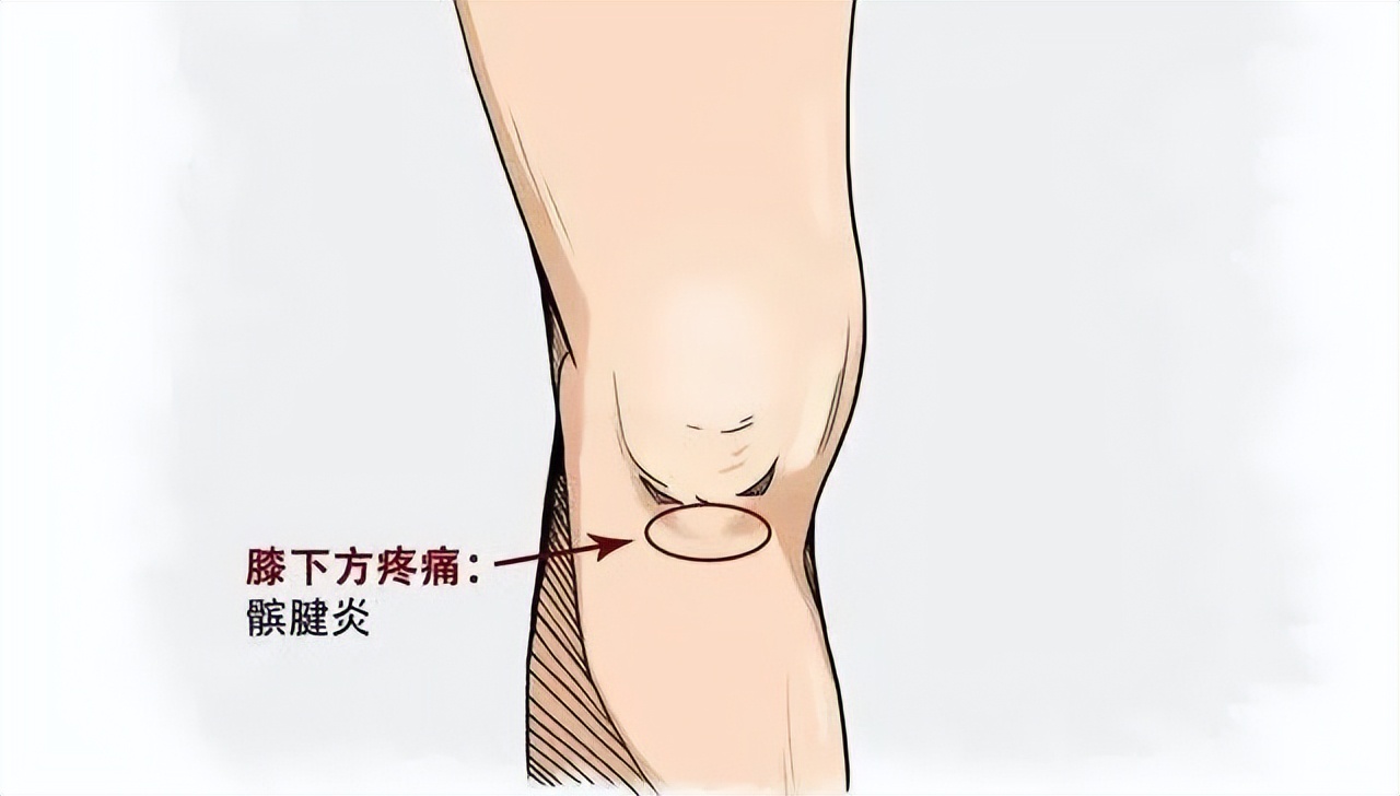 膝盖髌骨软骨疼痛部位对照表,膝盖下方胫骨疼痛部位对照表