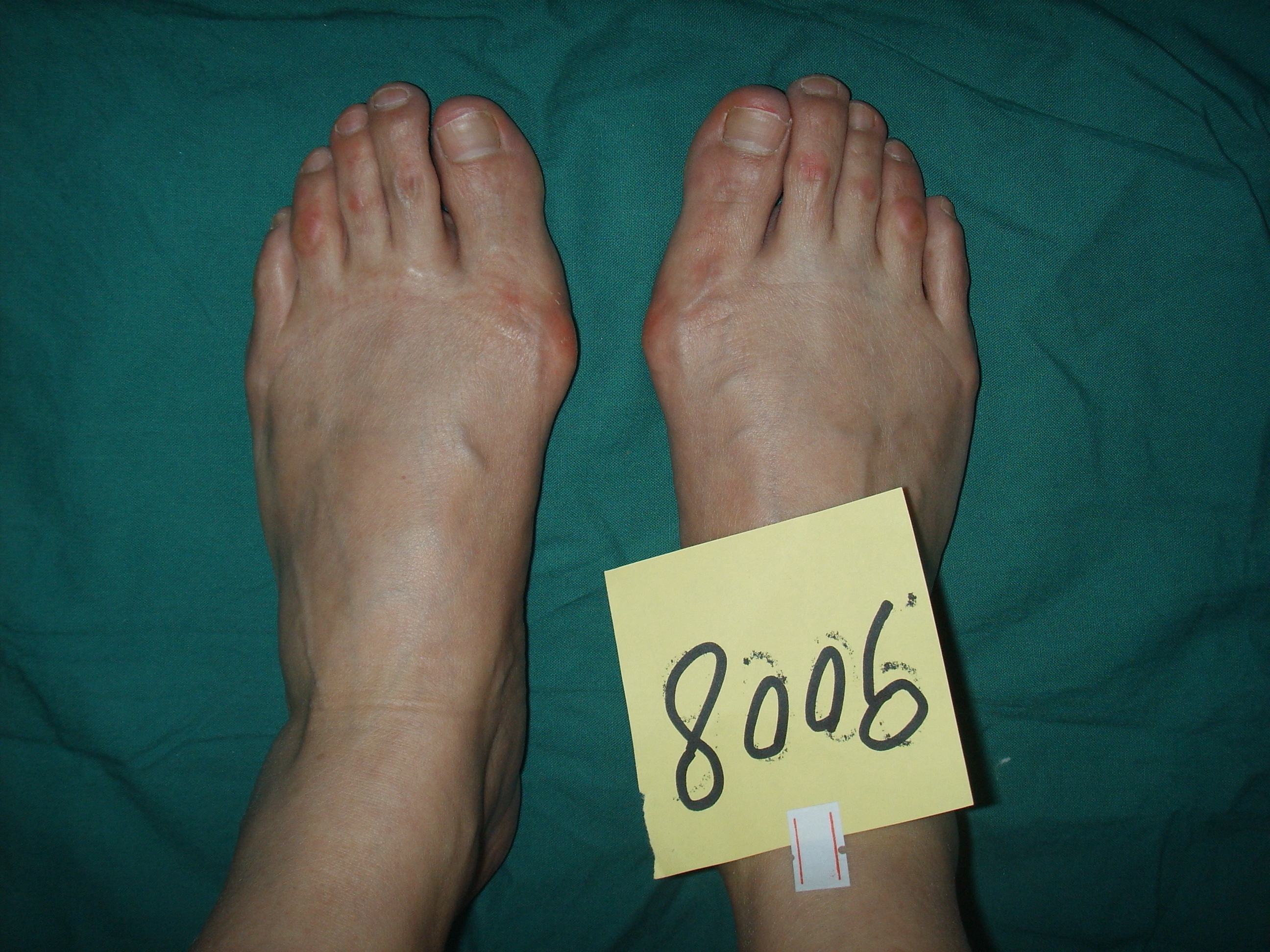 一个脚正常一个脚拇外翻,脚小趾拇外翻是怎么回事