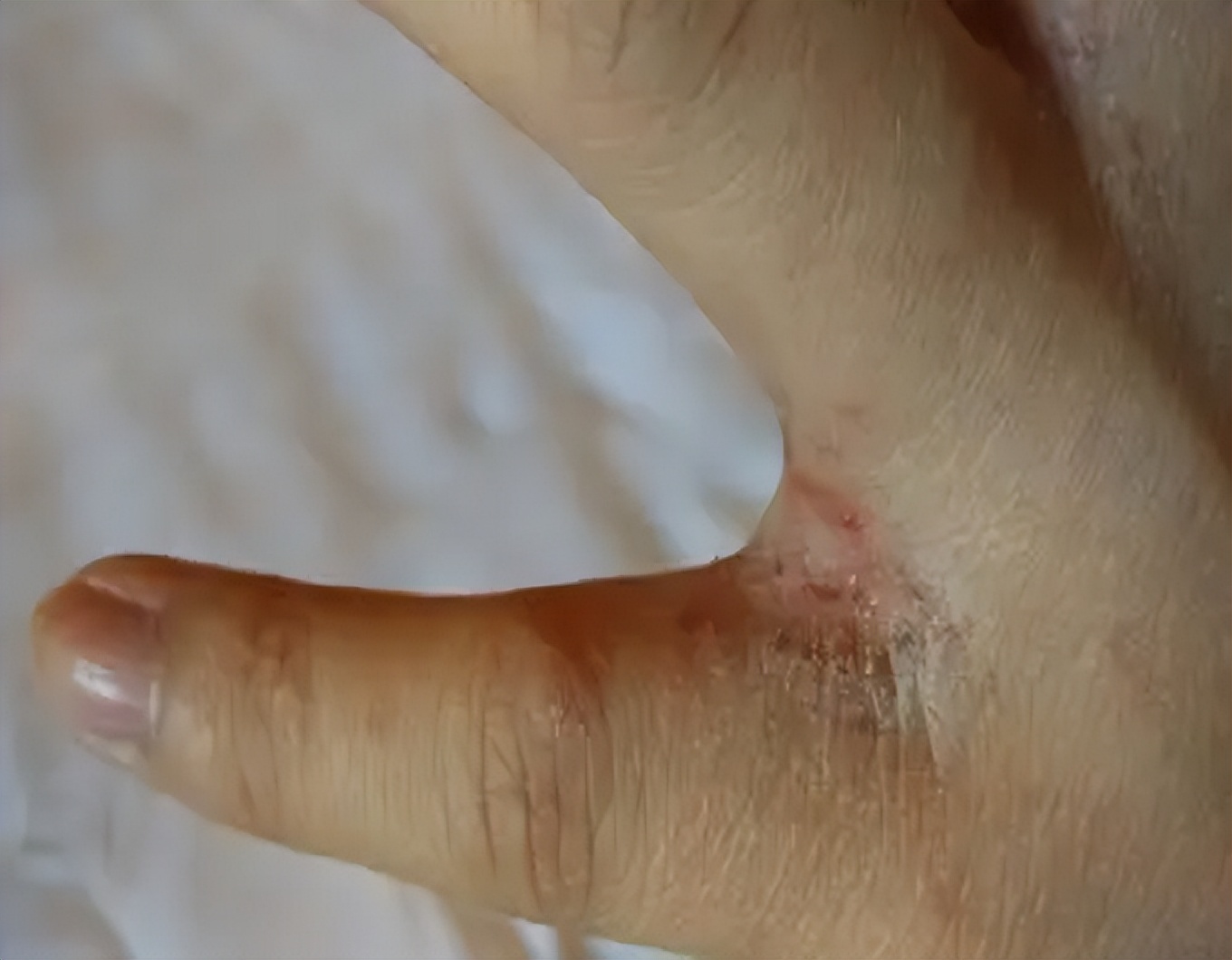 炉甘石万能药,万能止痒软膏配方