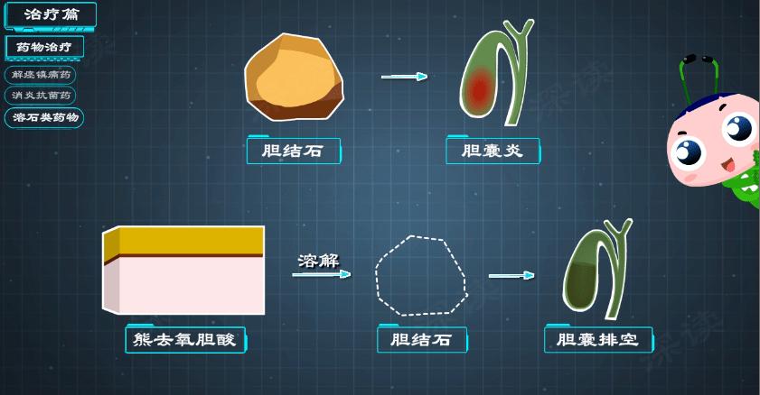 胆囊炎胆结石怎么保守治疗,胆结石胆囊炎胆绞痛发作