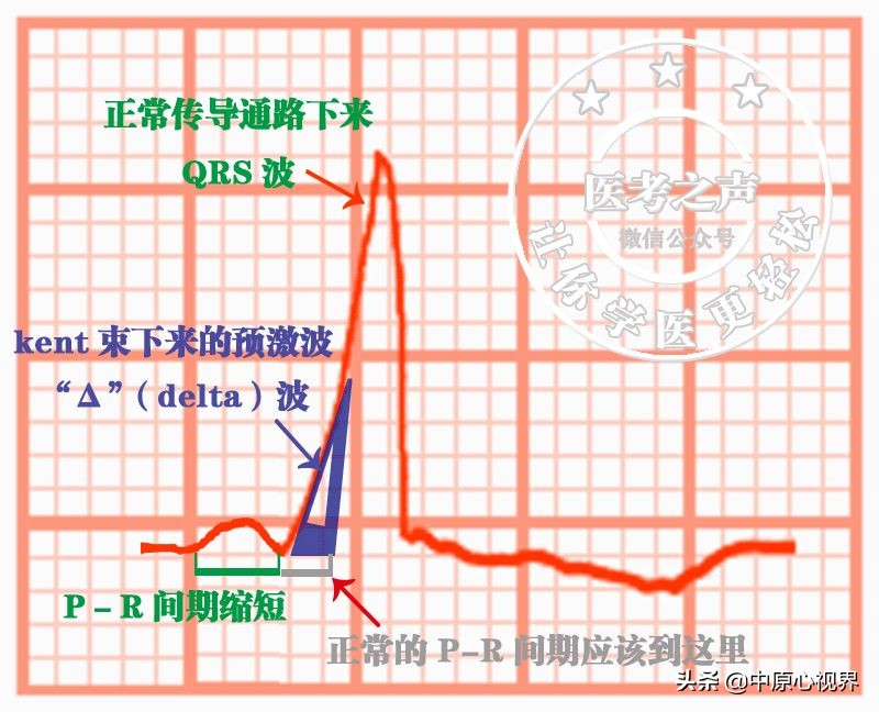 护考几种常见的心电图,常见的心电图图形分析
