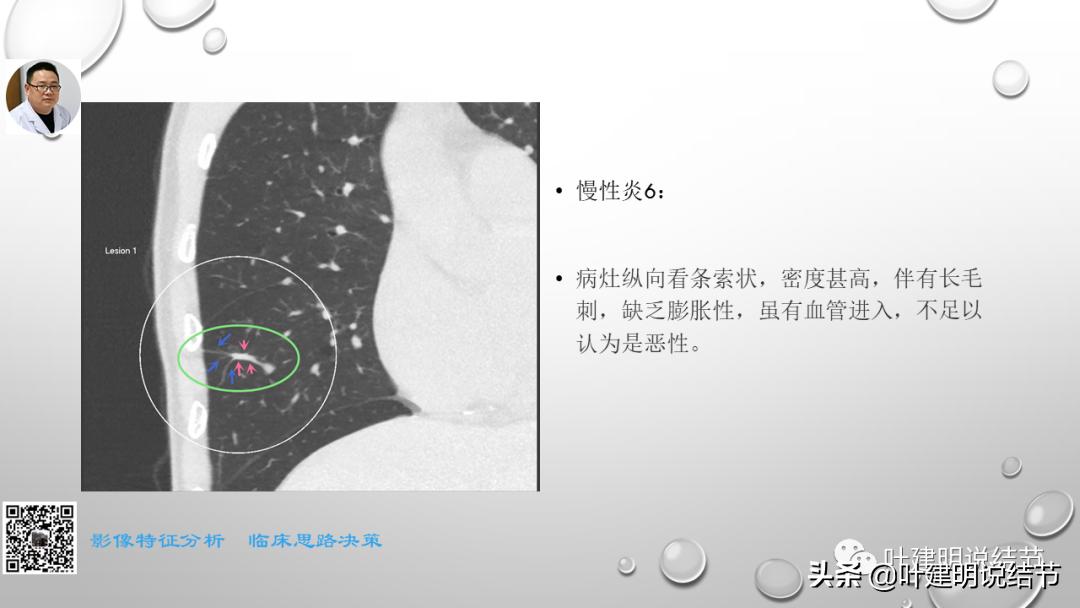 在《一脉阳光》呼吸影像诊断专题培训班上的讲课PPT（第一部分）