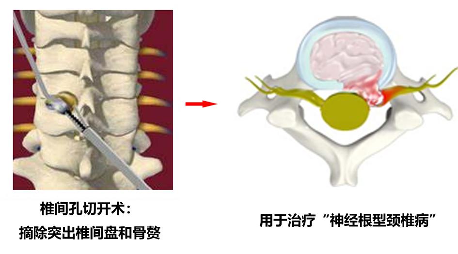 颈椎什么情况可以做微创手术,颈椎什么情况可做微创手术