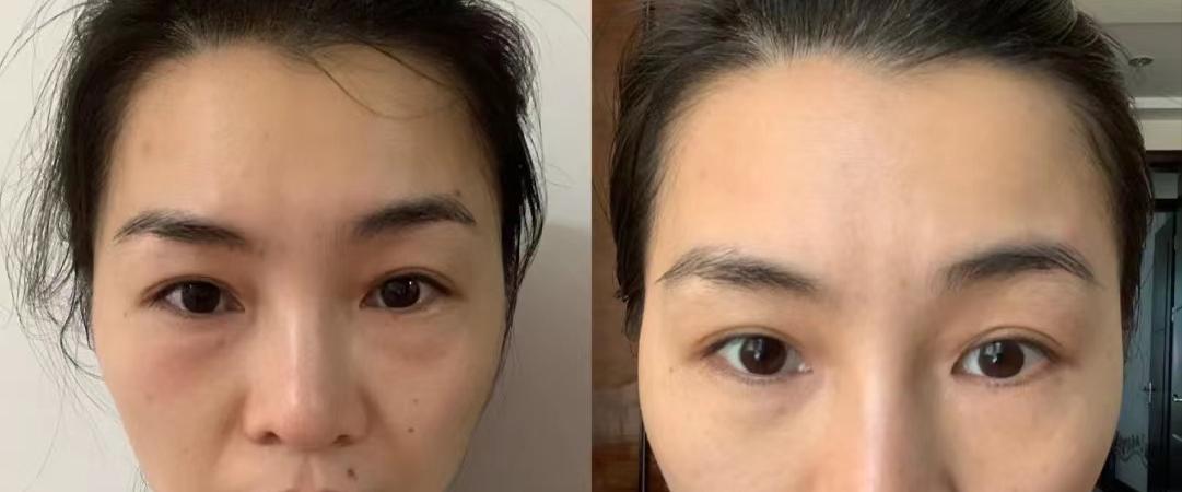 泪沟是凹陷还是下垂,泪沟是什么型的眼袋