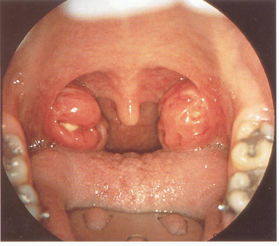 咽喉脓肿临床表现,咽旁脓肿临床表现与治疗